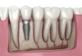 Dental Implants