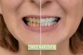 Smile Makeover